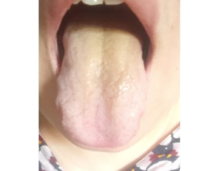 舌苔黃