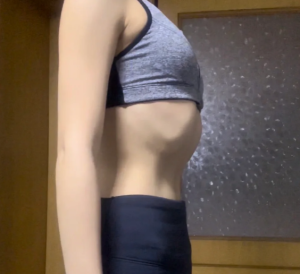 肋骨外翻