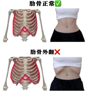 肋骨外翻