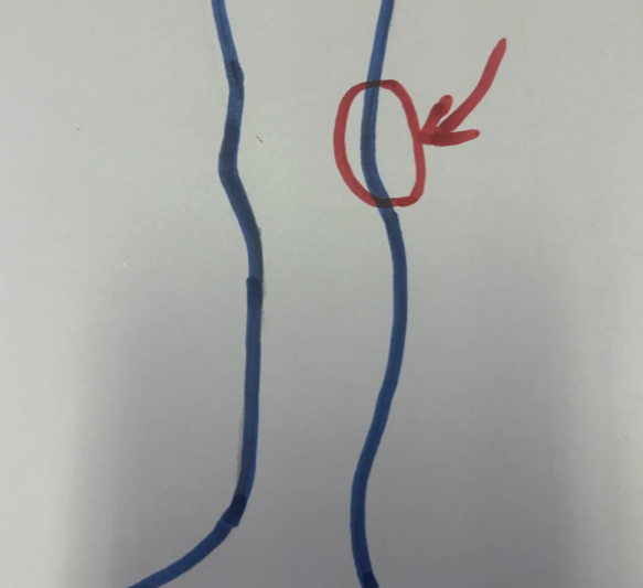 【膝蓋後面叫什麼】膝蓋後面痛：原因、危害與解決方案