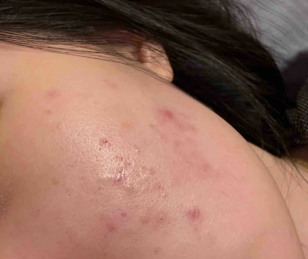 左臉頰長痘痘怎麼消？長痘痘位置代表著什麼，如何消除？