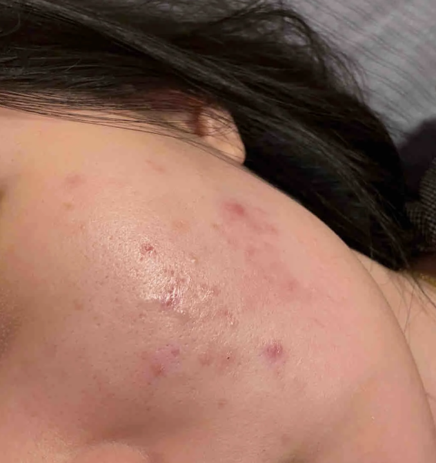左臉頰長痘痘怎麼消
