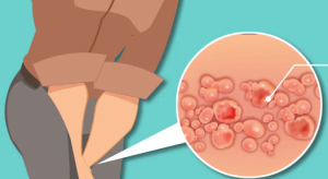 私密處皰疹症狀