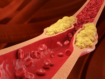 膽固醇過高原因公開！降膽固醇飲食、方法介紹&正常值介紹