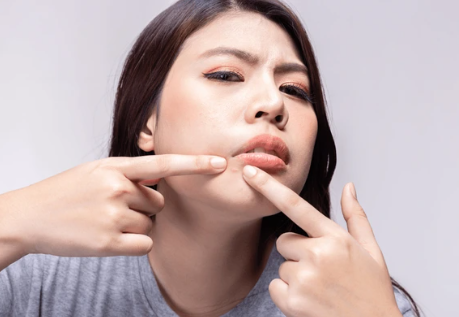 生理痘是什麼？生理痘怎麼消&如何正常護理、日常抗痘方法